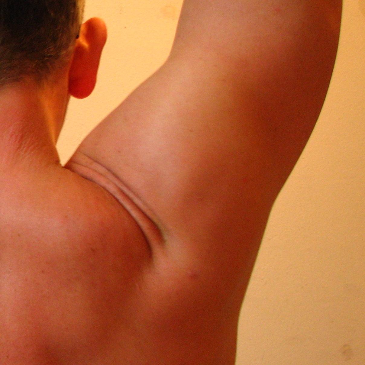 homem com artrite no ombro e braço levantado