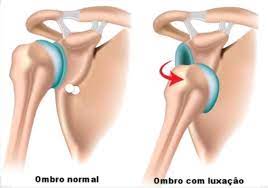 esquema mostrando Subluxacao do ombro